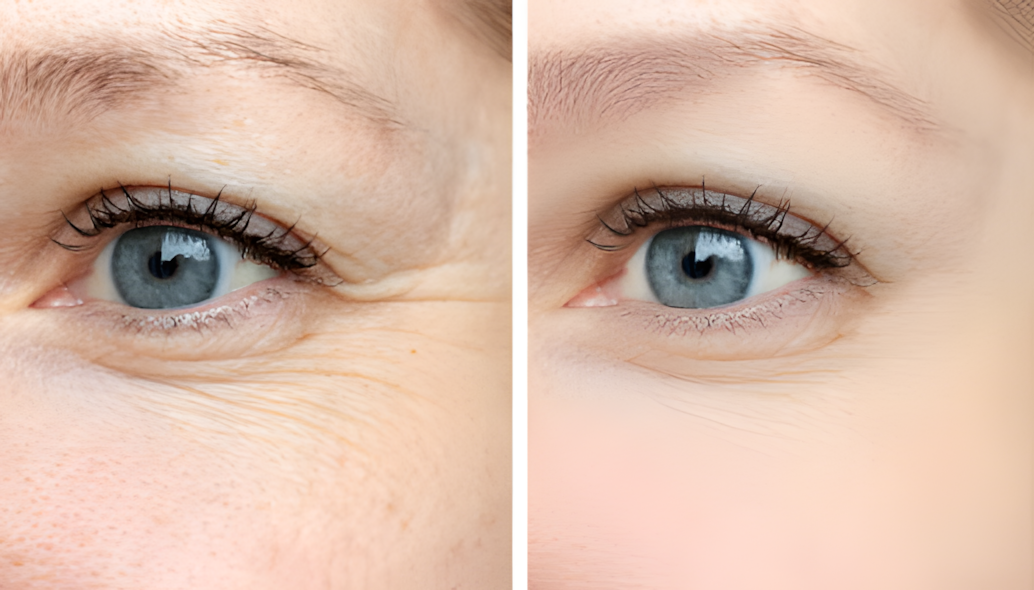 Skin Trouble Solution Series #3. Signs of Aging: Fine Lines and Wrinkles